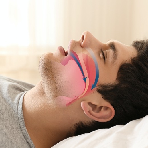 Man in need of sleep apnea screening snoring during sleep with animated airway over his facial profile